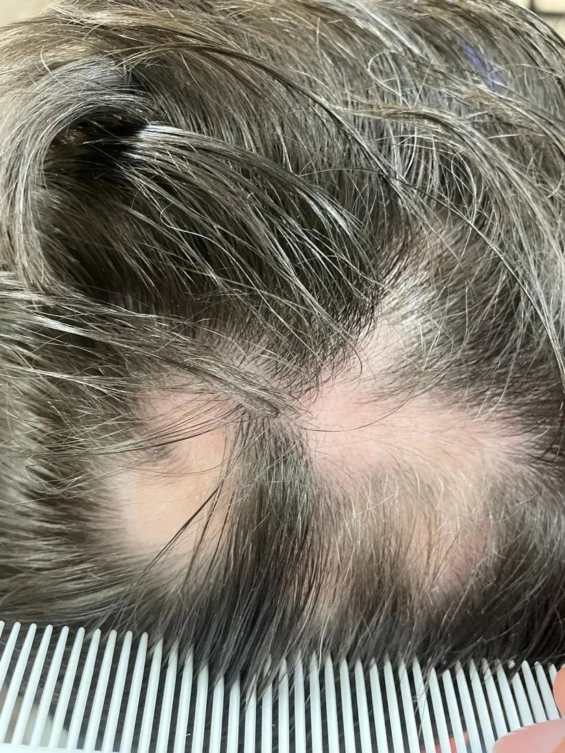 Placa de alopecia areata en el cuero cabelludo de una paciente atendida en dermaMER, Valencia