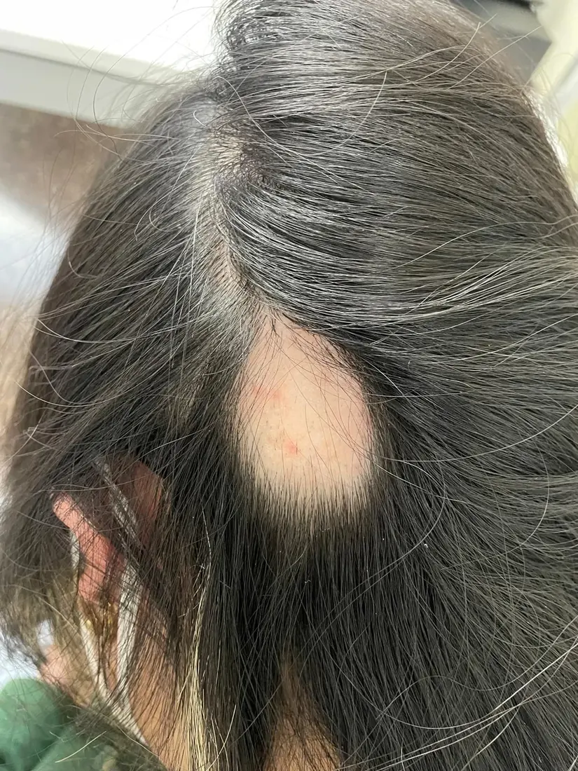 Segunda placa de alopecia areata en cuero cabelludo, vista durante la exploración en consulta