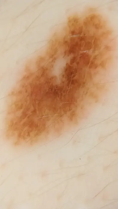 Imagen dermatoscópica de un lunar registrado durante una revisión en dermaMER, Valencia