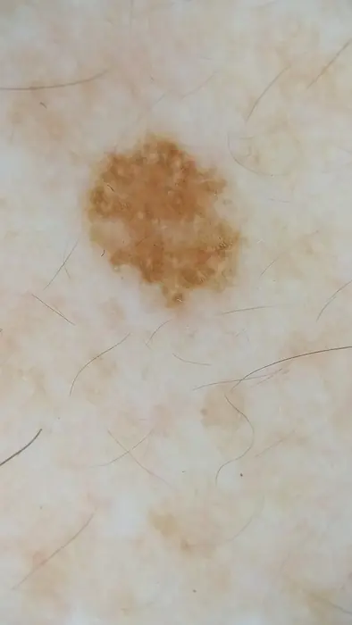 Imagen dermatoscópica de un segundo lunar registrado en la misma revisión