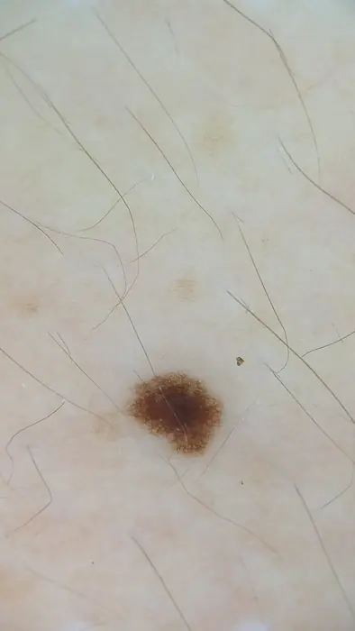 Imagen dermatoscópica de un tercer lunar registrado en la misma revisión