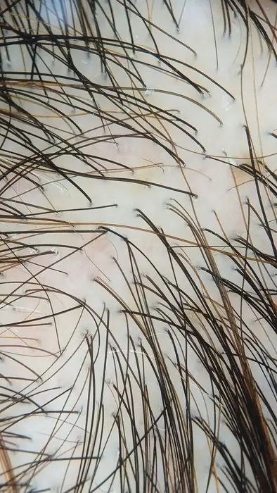 Imagen de tricoscopia digital del cuero cabelludo de un paciente con alopecia androgenética masculina, tomada en dermaMER, Valencia