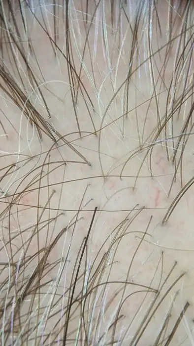 Tricoscopia digital del cuero cabelludo en la valoración de una alopecia androgenética