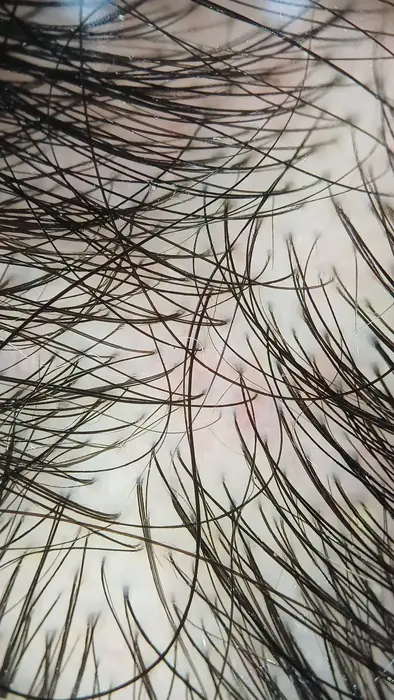 Imagen de tricoscopia digital del cuero cabelludo de una paciente con alopecia femenina, tomada en dermaMER, Valencia