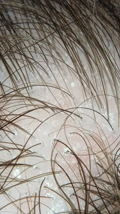 Tricoscopia digital: variabilidad de grosor del pelo en la valoración de una alopecia femenina