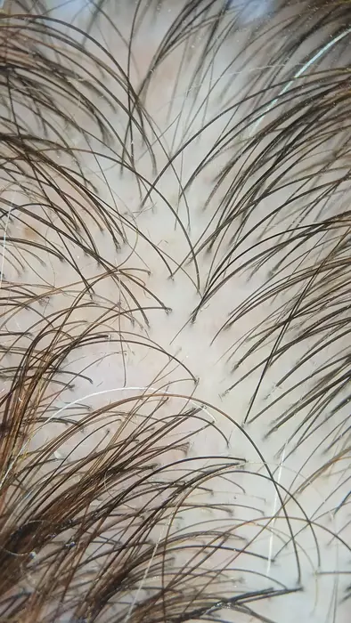 Tricoscopia digital del cuero cabelludo durante la exploración de una alopecia femenina