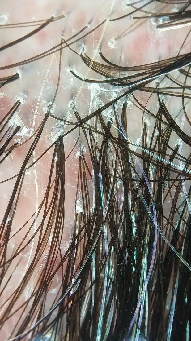 Tricoscopia digital de una foliculitis decalvante: varios pelos emergiendo de un mismo orificio folicular