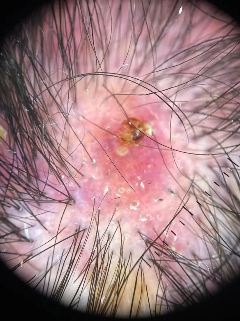Tricoscopia digital de una alopecia cicatricial por lupus cutáneo, con pérdida de los orificios foliculares