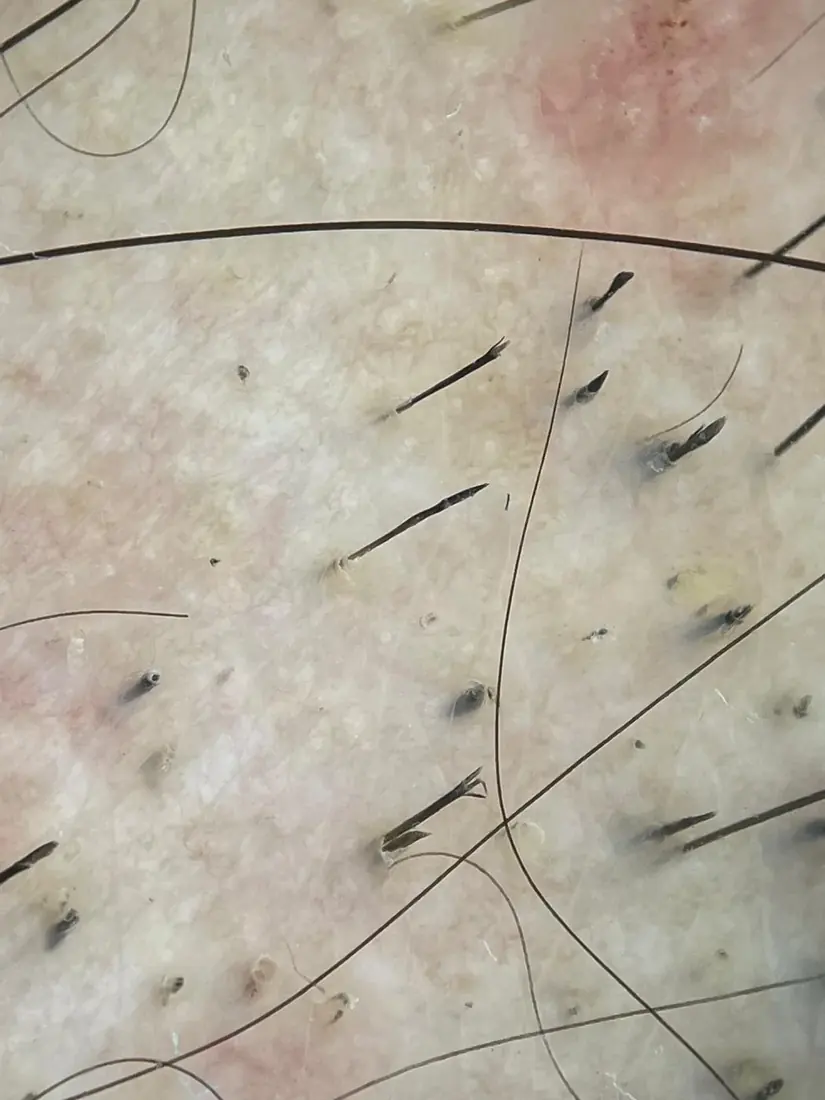 Tricoscopia digital de una tricotilomanía: pelos rotos a distintas alturas en la misma zona